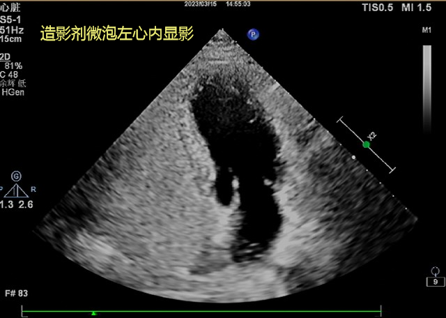 造影劑微泡左心內(nèi)顯影（.png